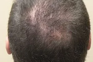 laser-therapy-before-and-after-patient-9-c laser-therapy-before-and-after-patient-9-c
