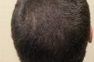 laser-therapy-before-and-after-patient-9-d laser-therapy-before-and-after-patient-9-d