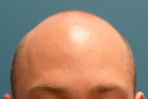mens-before-and-after-patient-1-a mens-before-and-after-patient-1-a