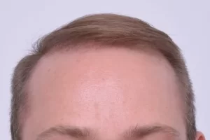 mens-before-and-after-patient-1-b mens-before-and-after-patient-1-b