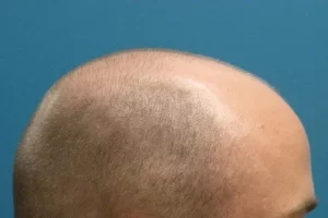 mens-before-and-after-patient-1-c mens-before-and-after-patient-1-c
