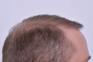 mens-before-and-after-patient-1-d mens-before-and-after-patient-1-d