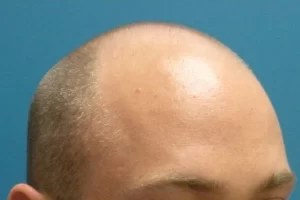 mens-before-and-after-patient-1-e mens-before-and-after-patient-1-e