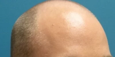 mens-before-and-after-patient-1-e mens-before-and-after-patient-1-e
