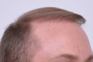 mens-before-and-after-patient-1-f mens-before-and-after-patient-1-f