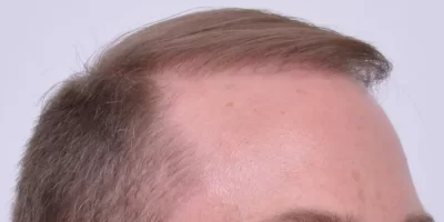 mens-before-and-after-patient-1-f mens-before-and-after-patient-1-f