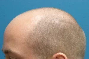 mens-before-and-after-patient-1-g mens-before-and-after-patient-1-g