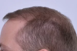 mens-before-and-after-patient-1-h mens-before-and-after-patient-1-h