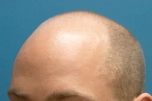 mens-before-and-after-patient-1-i mens-before-and-after-patient-1-i