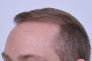 mens-before-and-after-patient-1-j mens-before-and-after-patient-1-j