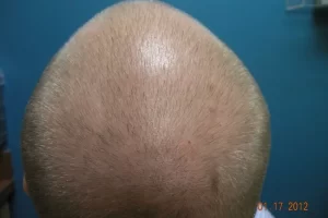 mens-before-and-after-patient-1-k mens-before-and-after-patient-1-k