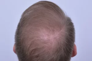 mens-before-and-after-patient-1-l mens-before-and-after-patient-1-l