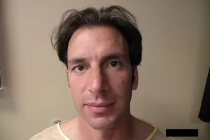 mens-before-and-after-patient-10-a mens-before-and-after-patient-10-a