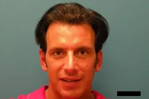 mens-before-and-after-patient-10-b mens-before-and-after-patient-10-b
