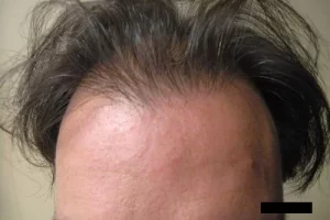 mens-before-and-after-patient-10-c mens-before-and-after-patient-10-c