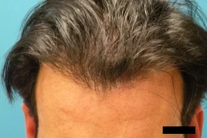 mens-before-and-after-patient-10-d mens-before-and-after-patient-10-d