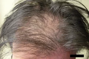 mens-before-and-after-patient-10-e mens-before-and-after-patient-10-e