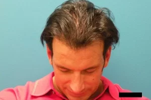 mens-before-and-after-patient-10-f mens-before-and-after-patient-10-f