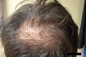 mens-before-and-after-patient-10-g mens-before-and-after-patient-10-g