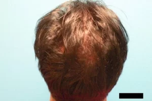 mens-before-and-after-patient-10-h mens-before-and-after-patient-10-h