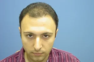 mens-before-and-after-patient-11-a mens-before-and-after-patient-11-a