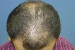 mens-before-and-after-patient-11-c mens-before-and-after-patient-11-c