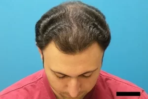 mens-before-and-after-patient-11-d mens-before-and-after-patient-11-d