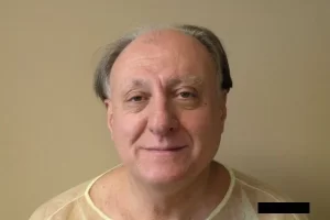 mens-before-and-after-patient-12-a mens-before-and-after-patient-12-a