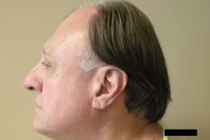 mens-before-and-after-patient-12-c mens-before-and-after-patient-12-c