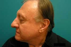 mens-before-and-after-patient-12-d mens-before-and-after-patient-12-d
