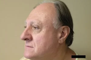 mens-before-and-after-patient-12-e mens-before-and-after-patient-12-e