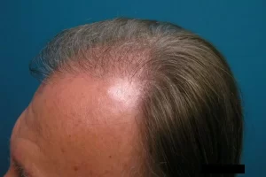 mens-before-and-after-patient-12-f mens-before-and-after-patient-12-f