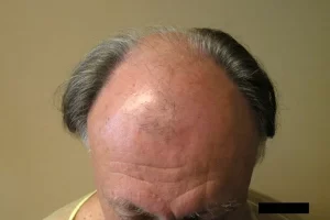mens-before-and-after-patient-12-g mens-before-and-after-patient-12-g