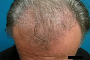 mens-before-and-after-patient-12-h mens-before-and-after-patient-12-h