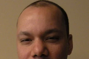 mens-before-and-after-patient-13-a mens-before-and-after-patient-13-a