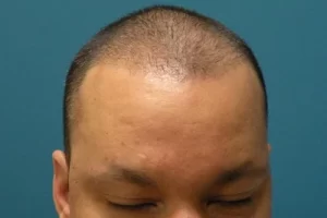 mens-before-and-after-patient-13-b mens-before-and-after-patient-13-b