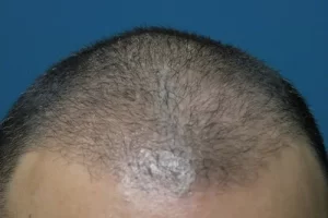 mens-before-and-after-patient-13-d mens-before-and-after-patient-13-d