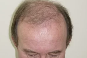 mens-before-and-after-patient-14-a mens-before-and-after-patient-14-a