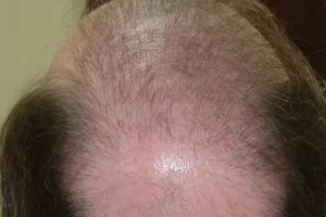 mens-before-and-after-patient-14-c mens-before-and-after-patient-14-c