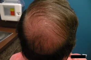 mens-before-and-after-patient-14-d mens-before-and-after-patient-14-d