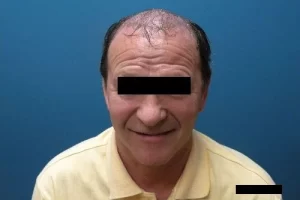 mens-before-and-after-patient-15-a mens-before-and-after-patient-15-a