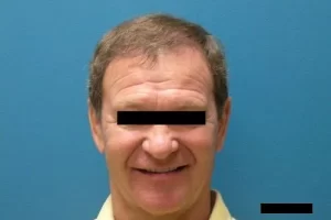 mens-before-and-after-patient-15-b mens-before-and-after-patient-15-b