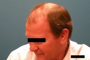 mens-before-and-after-patient-15-c mens-before-and-after-patient-15-c