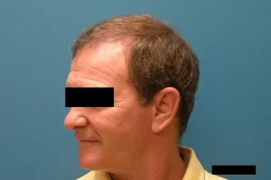 mens-before-and-after-patient-15-d mens-before-and-after-patient-15-d