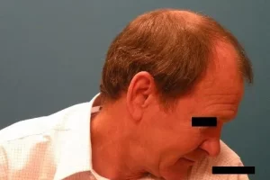 mens-before-and-after-patient-15-e mens-before-and-after-patient-15-e