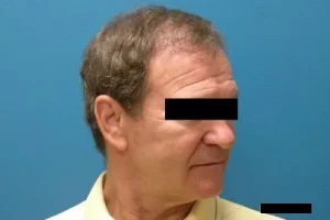 mens-before-and-after-patient-15-f mens-before-and-after-patient-15-f