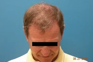mens-before-and-after-patient-15-g mens-before-and-after-patient-15-g