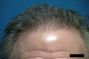 mens-before-and-after-patient-16-b mens-before-and-after-patient-16-b