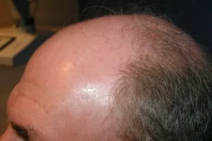 mens-before-and-after-patient-16-e mens-before-and-after-patient-16-e