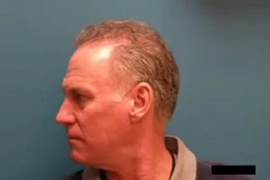 mens-before-and-after-patient-16-f mens-before-and-after-patient-16-f